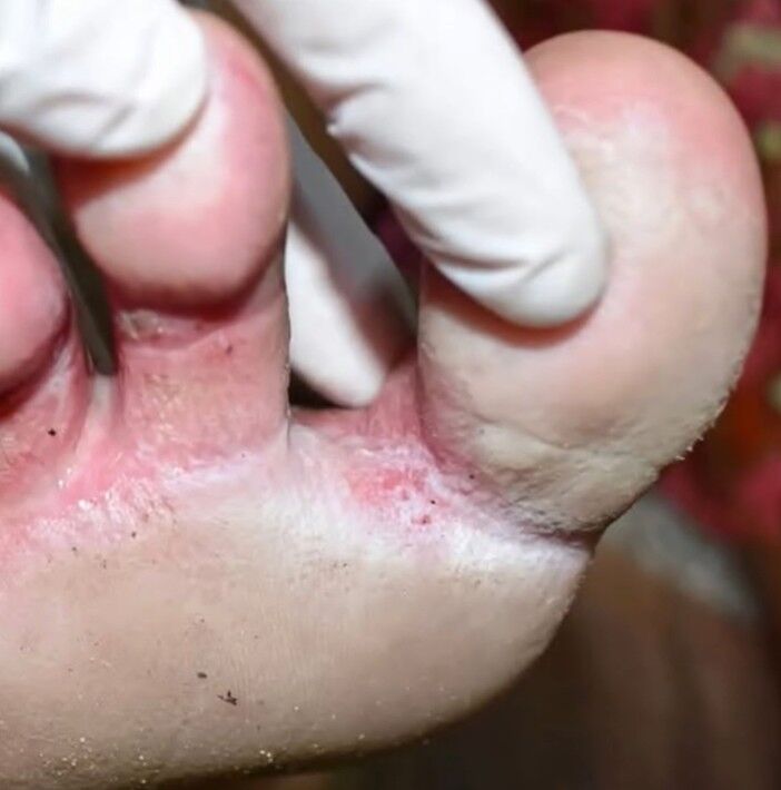 Looks like a infection between my toes. Can’t get medical advice for now. Any over-the-counter remedies?. Full article