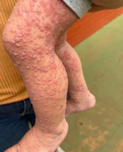 His whole body was itchy, he thought it was an allergy and was diagnosed!