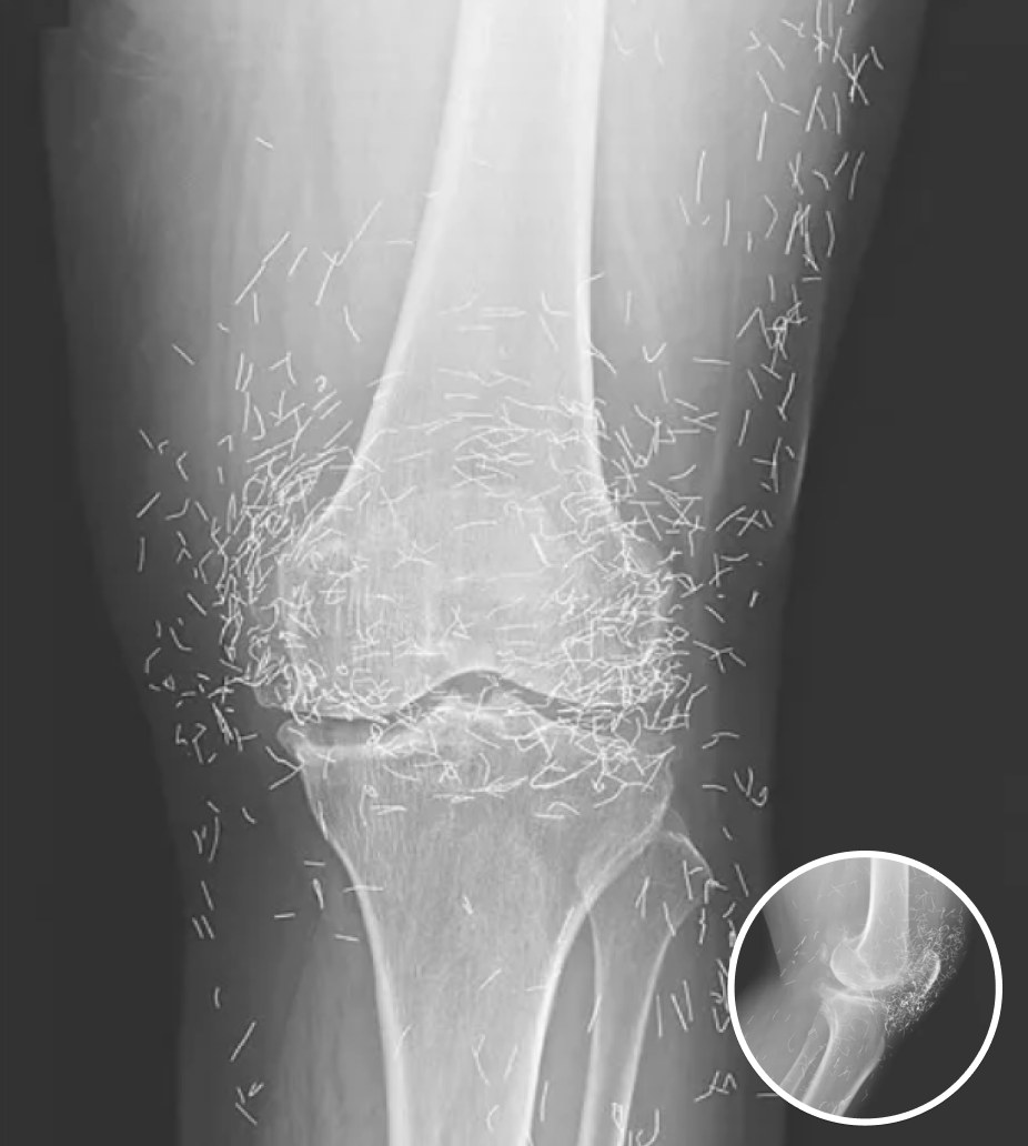 Doctors Stunned After Looking At This X-Ray Of Woman Suffering Joint Pain!