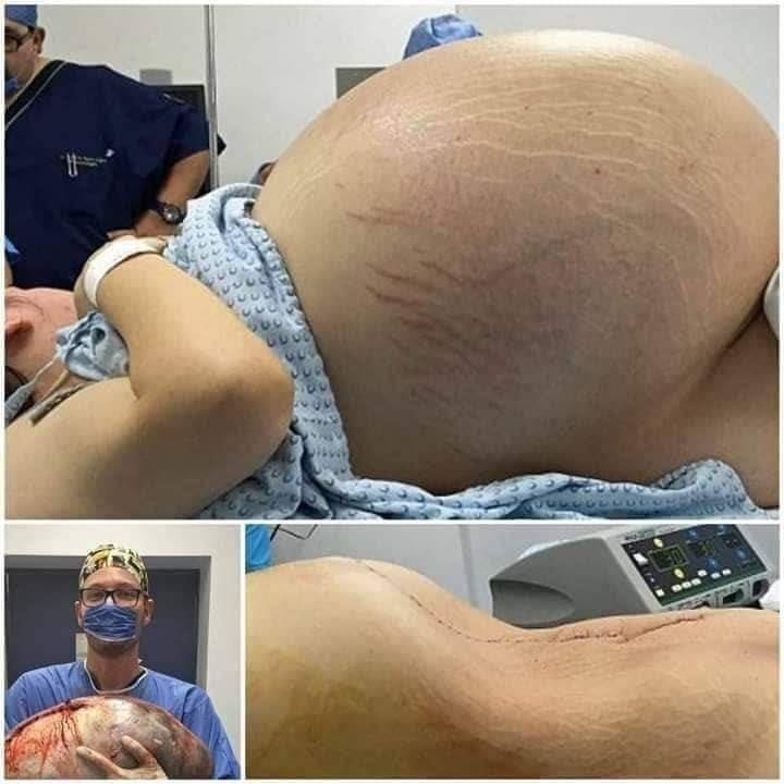 Tears of Joy Turn to Shock! A Pregnant Woman Expecting Triplets Leaves Doctors Stunned by Terrifying Discovery During C-Section